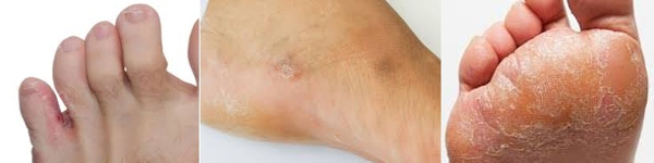 Tavi medve pikkelysömör kezelése - A lábán vörös folt, mint a kiütés